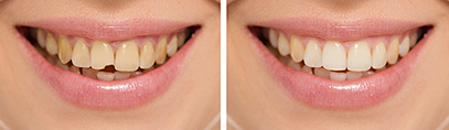 Veneers | Bailey Hill Dental | Dentist Springfield OR