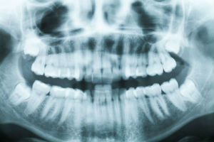 Digital X-Rays | Bailey Hill Dental | Dentist Eugene OR