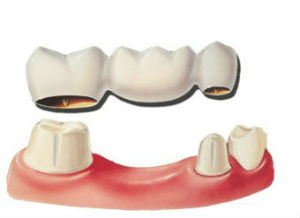 Dental Bridges | Bailey Hill Dental | Dentist Eugene OR