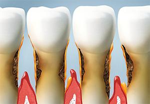 Gum Disease Treatment | Bailey Hill Dental | Dentist Eugene OR