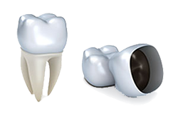 Dental Crowns | Dr. Dean, Dentist Eugene, OR